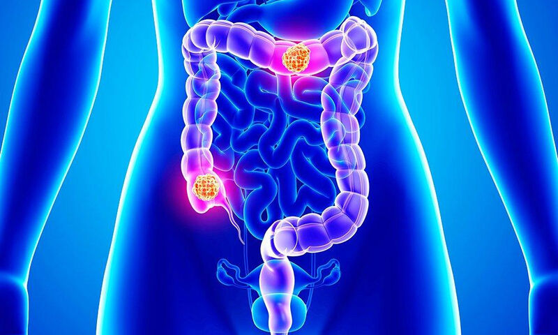 colon and rectal cancers